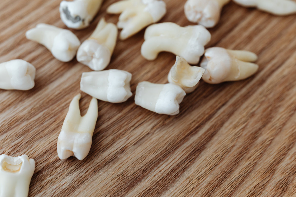 5 Signs Your Wisdom Teeth May Need to Be Removed