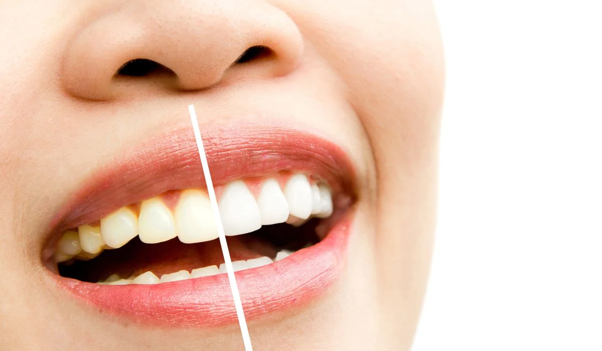 Teeth Bleaching Dentist