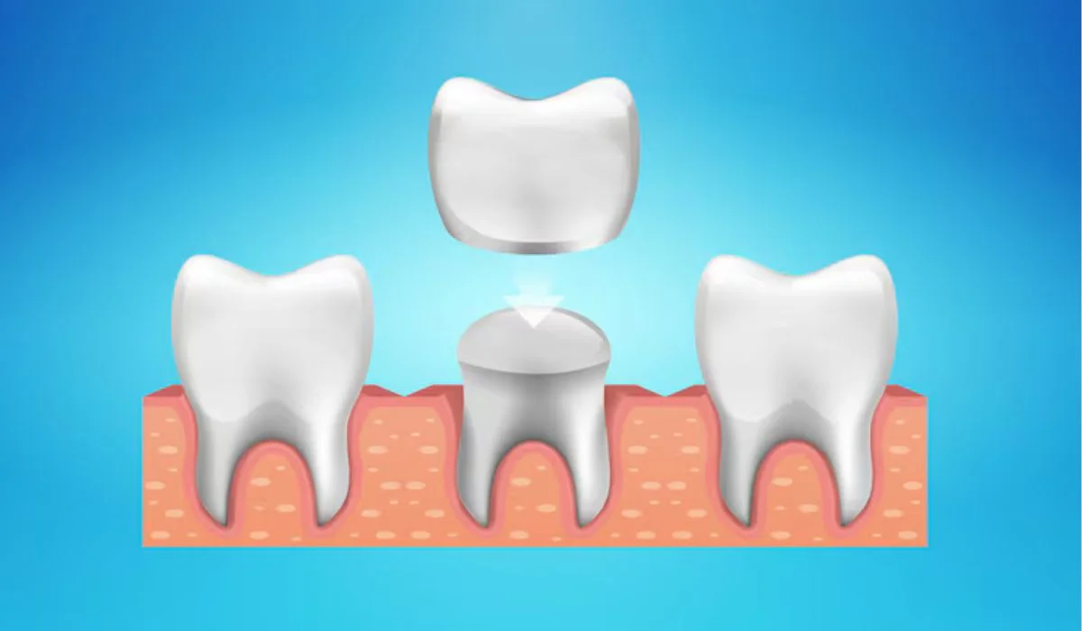 Temporary Dental Crown