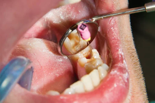 Root-canal-treatment, CA