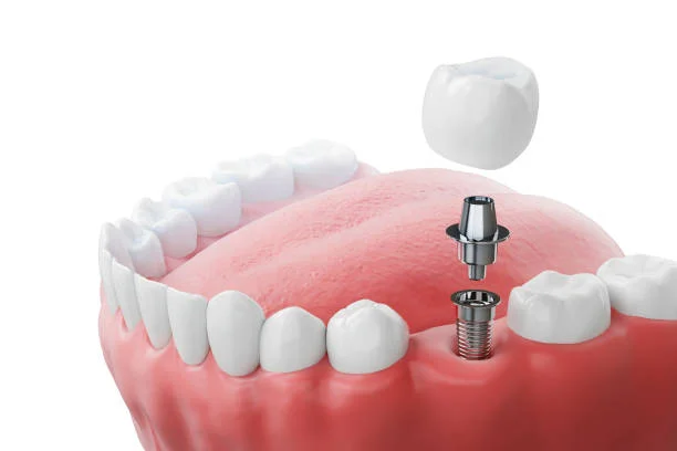 Dental Impant
