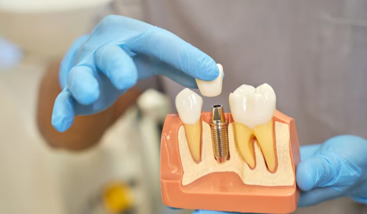 dental implant in Burbank