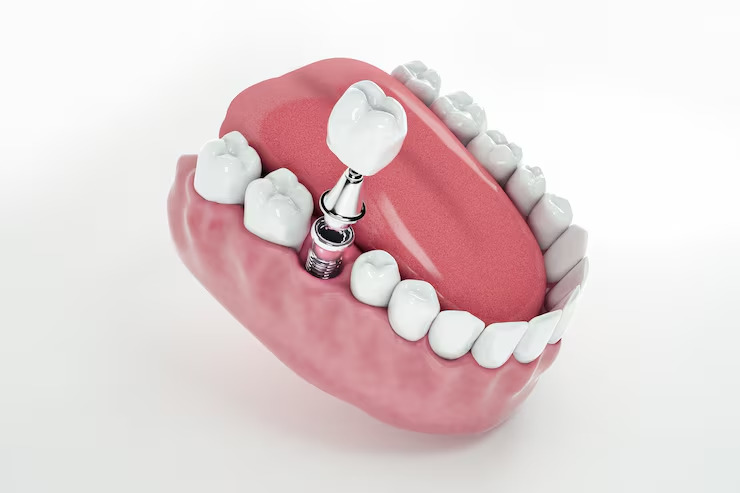 dental implants in Burbank