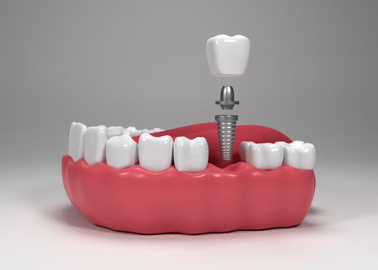 dental implants in Burbank