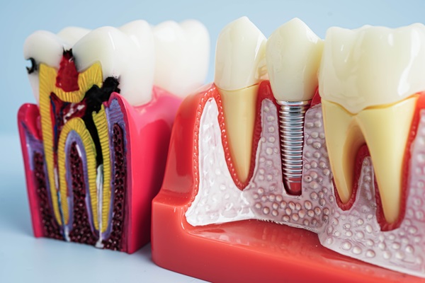 Implant Dentistry FAQs About Multiple Tooth Replacement